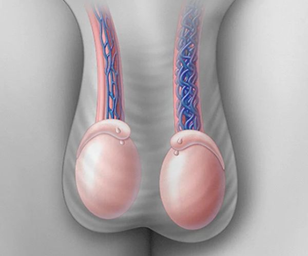 تورم الخصية بعد عملية دوالي الخصية