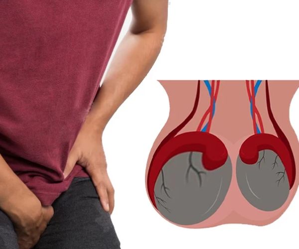 تورم الخصية بعد عملية دوالي الخصية