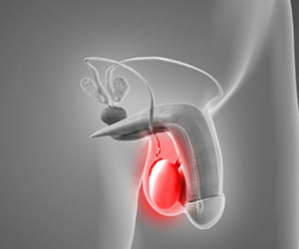 علاج تورم الخصية