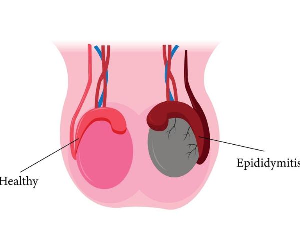 علاج تورم الخصية