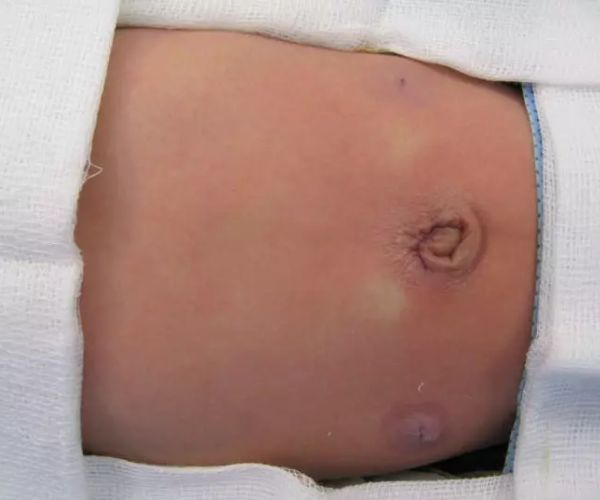 علاج الفتق الاربي عند الاطفال