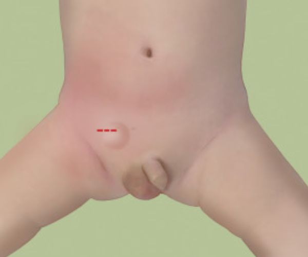 علاج الفتق الاربي عند الاطفال