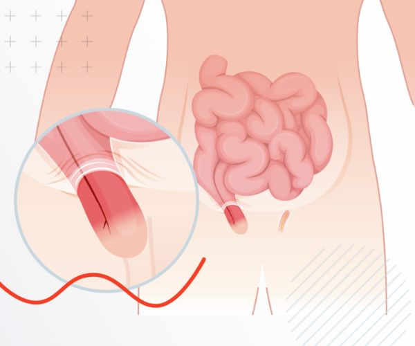 عملية فتق الخصية للاطفال