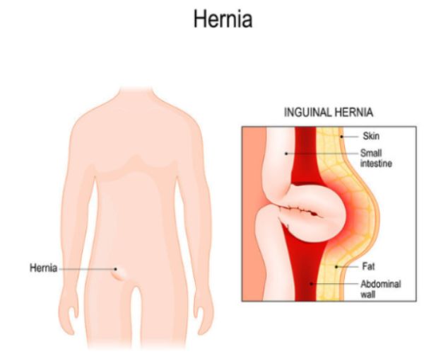 انواع الفتق عند الاطفال