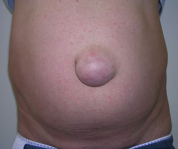 انواع الفتق عند الاطفال