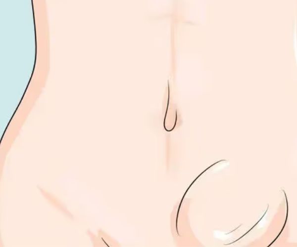 الفتق الاربي في الخصية عند الأطفال