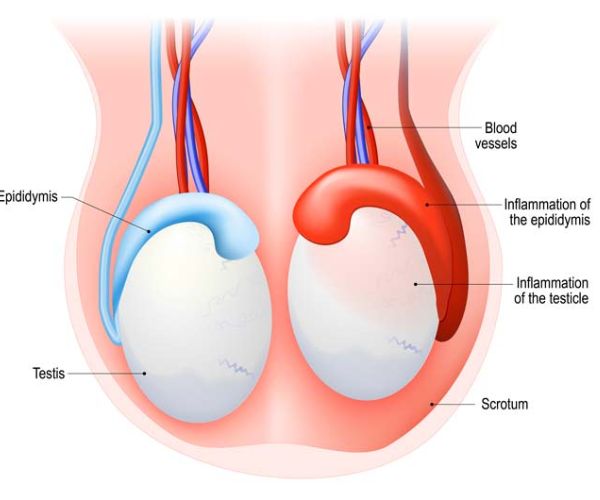 اسباب تورم الخصية عند الاطفال