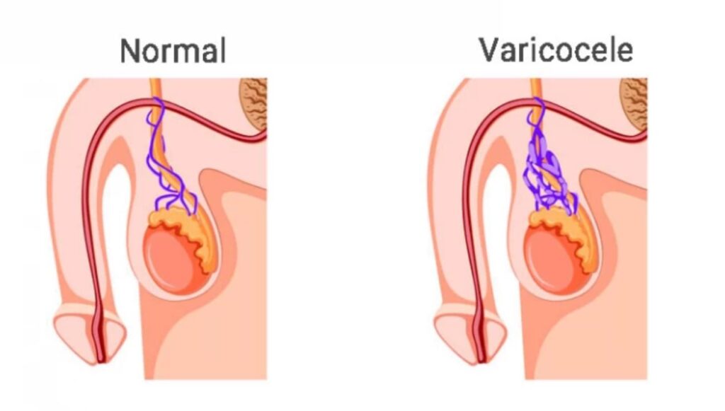 تورم الخصية بعد عملية دوالي الخصية