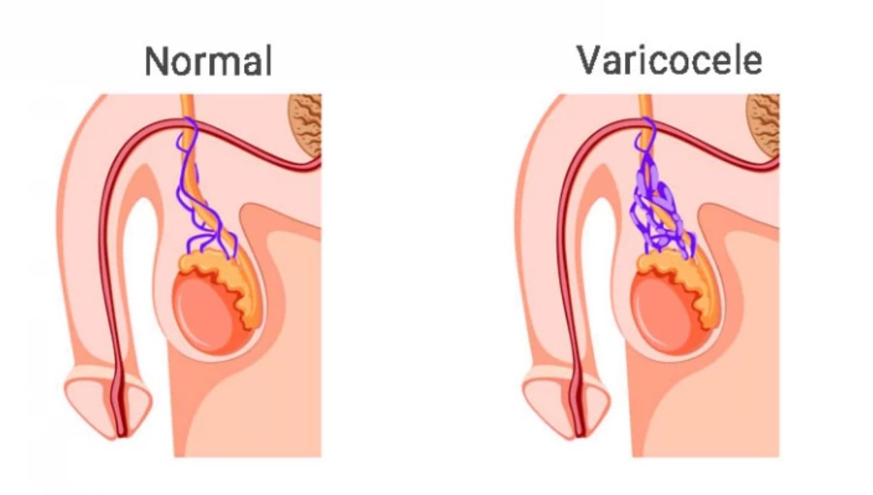 تورم الخصية بعد عملية دوالي الخصية: المضاعفات وطرق العلاج