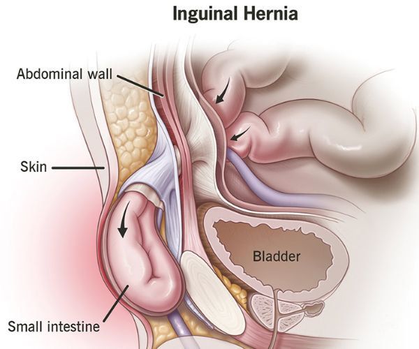 علاج الفتق الإربي بدون جراحة