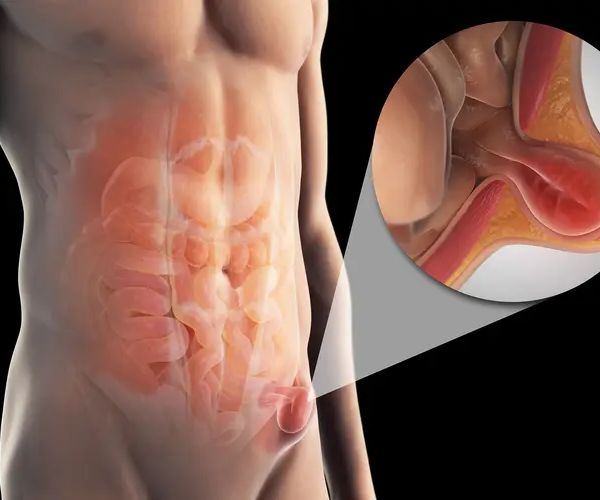 علاج الفتق الإربي بدون جراحة