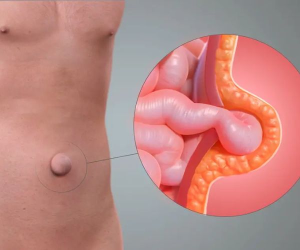 افضل جراح فتق للاطفال