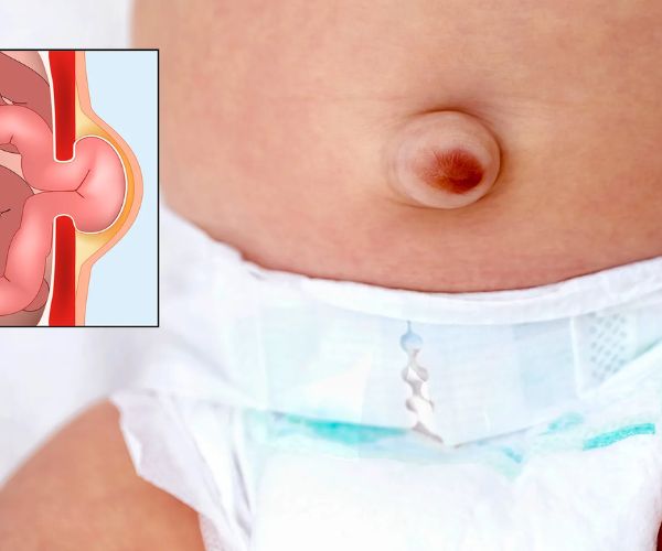 افضل جراح فتق للاطفال