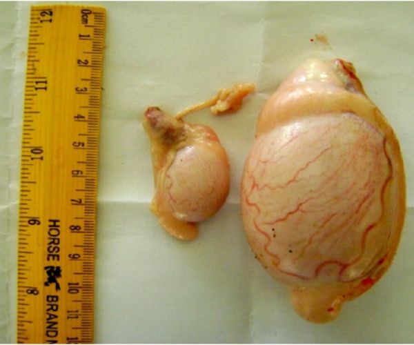 ضمور الخصية بعد عملية الفتق