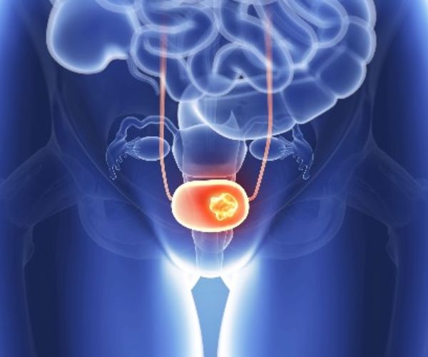 عملية توسيع مجري البول للاطفال