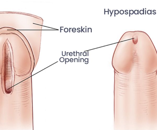 عملية الإحليل السفلي