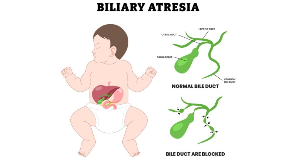 رتق القناة الصفراوية عند الأطفال