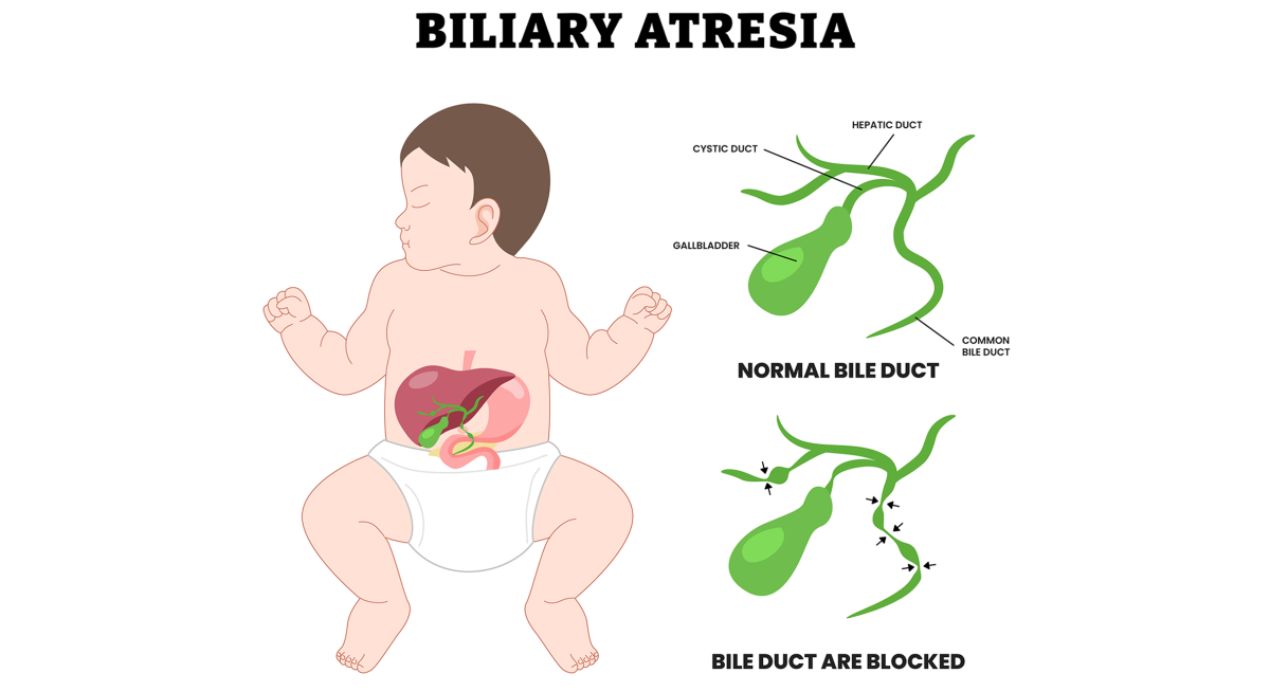 رتق القناة الصفراوية عند الأطفال: الأسباب والعلاج 2025