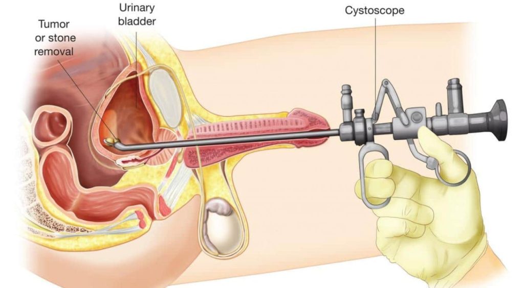 نصائح بعد عملية توسيع مجرى البول
