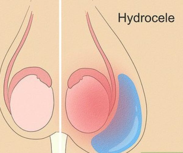 القيلة المائية في الخصوصية عند الأطفال