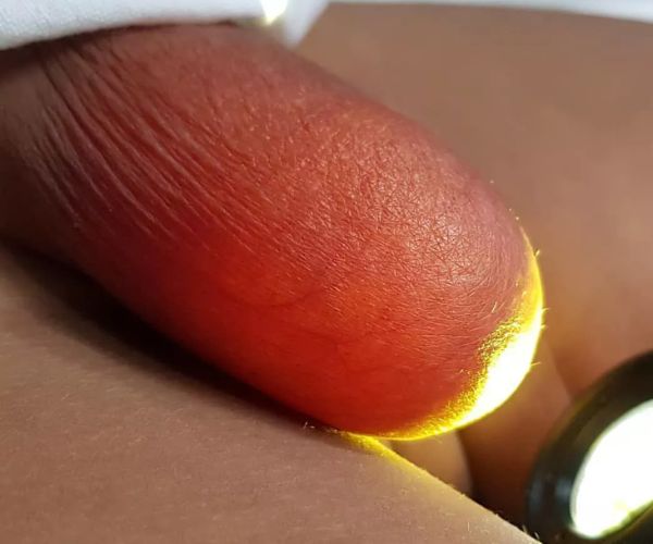 القيلة المائية في الخصوصية عند الأطفال