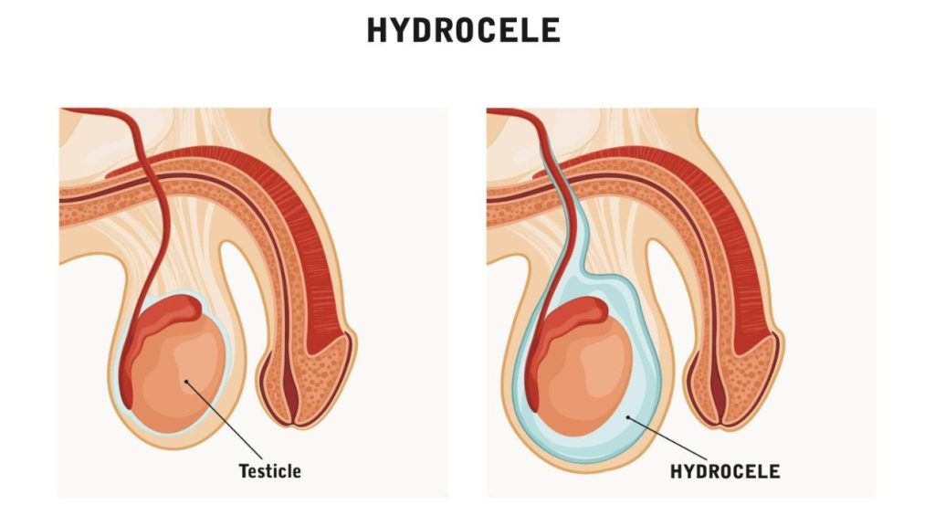 القيلة المائية في الخصوصية عند الأطفال