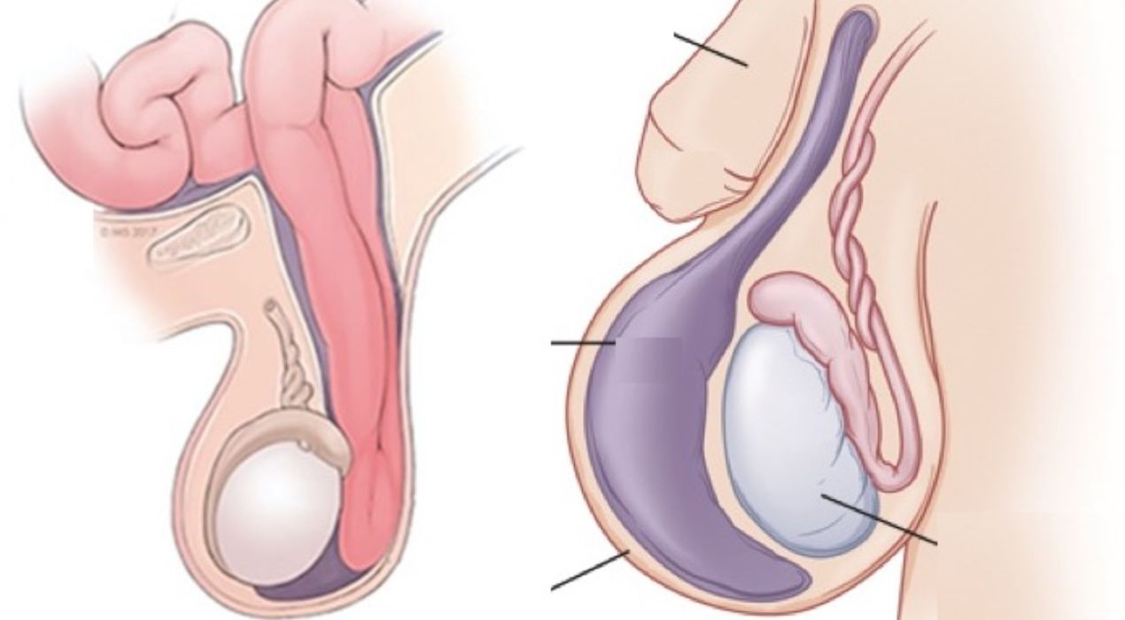 ما هو الفرق بين القيلة المائية والفتق الاربي؟…اليك الاجابة