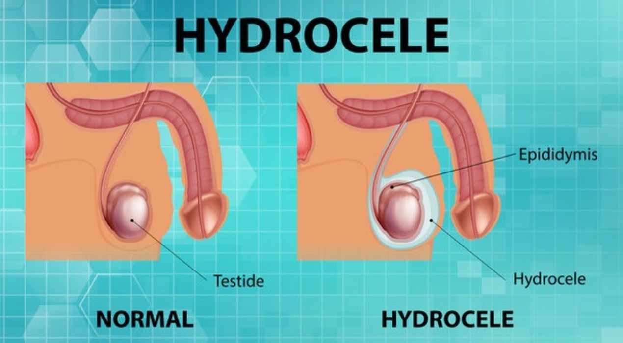 تجربتي مع القيلة المائية للأطفال ونصائح بعد العملية 2025