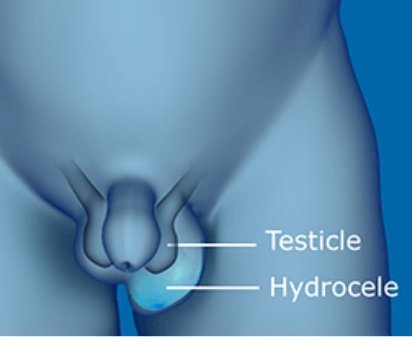 القيلة المائية للأطفال ونصائح بعد العملية 