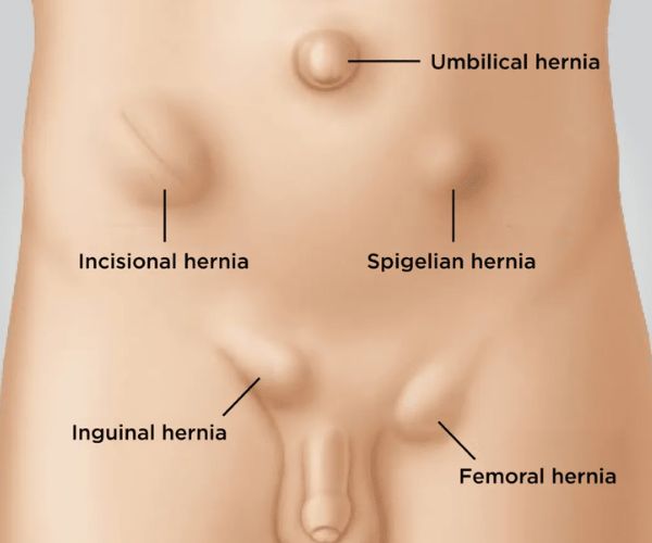 لجراح الفتق العربيه للاطفال