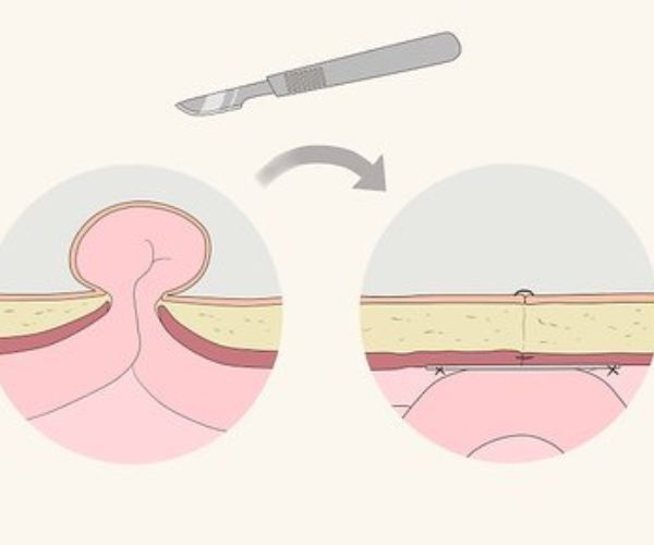 لجراح الفتق العربيه للاطفال