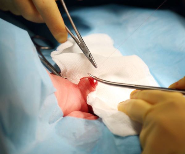 مدة شفاء الطفل بعد الختان