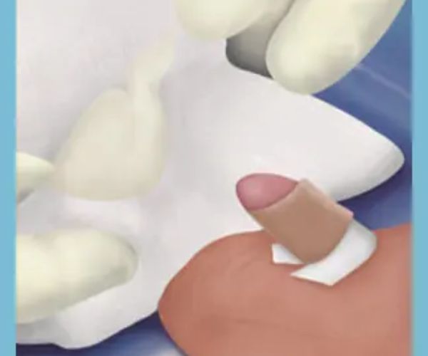 مدة شفاء الطفل بعد الختان