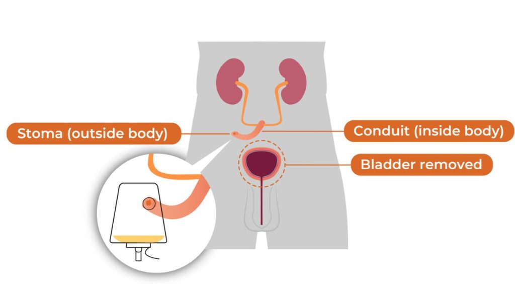 عملية تعديل فتحة البول