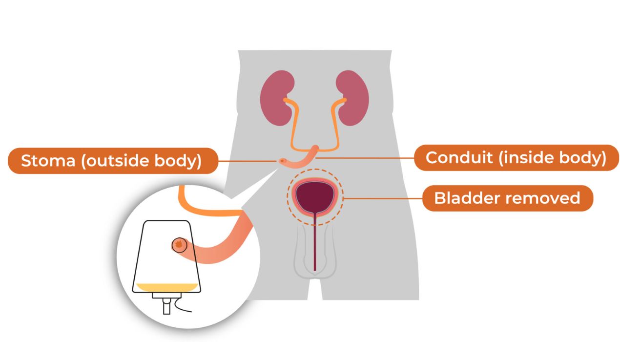 كل ما تحتاج معرفته عن عملية تعديل فتحة البول للأطفال 2025