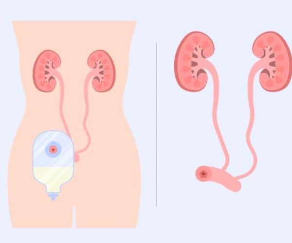 عملية تعديل فتحة البول