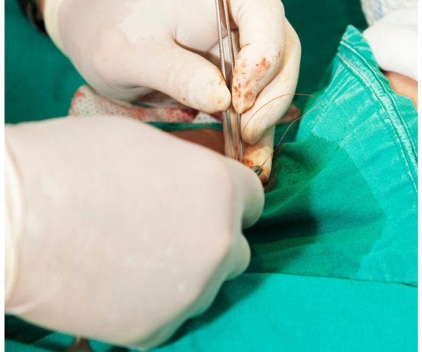 انواع الختان للذكور