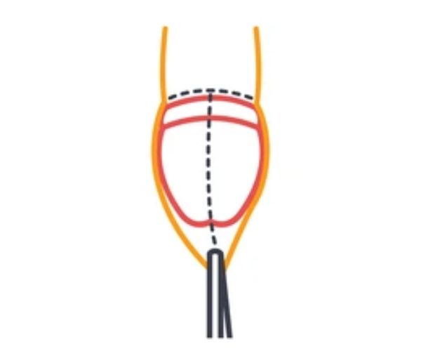 انواع الختان للذكور