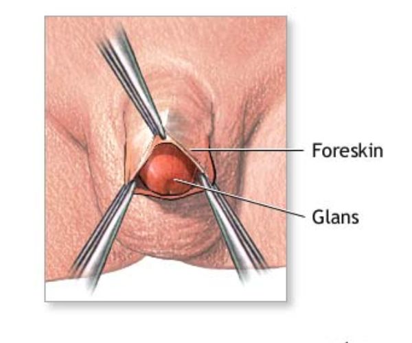 انواع الختان للذكور
