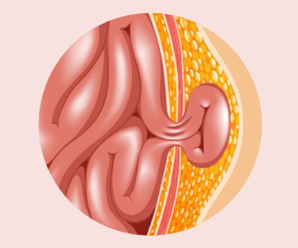 سعر جراحة فتق الخصية للأطفال