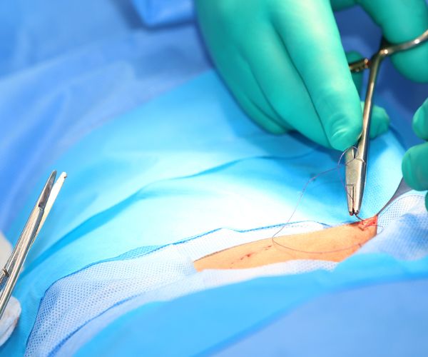 سعر جراحة فتق الخصية للأطفال