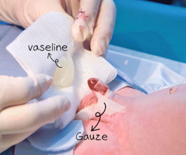 العناية بالطفل بعد الختان (الطهارة)