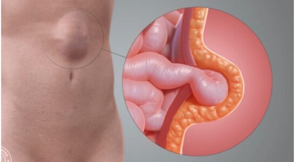 عملية الفتق بالمنظار للأطفال