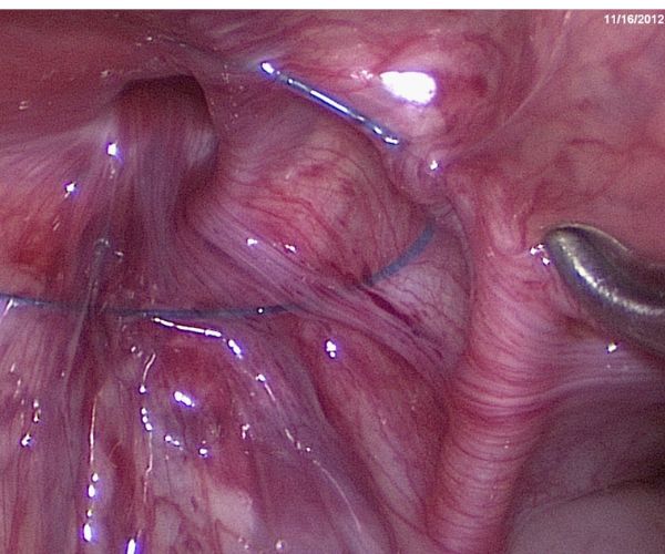 عملية الفتق بالمنظار للأطفال