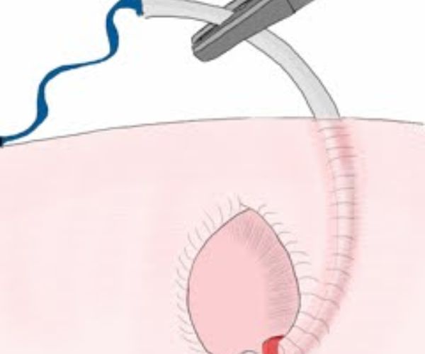 عملية الفتق بالمنظار للأطفال