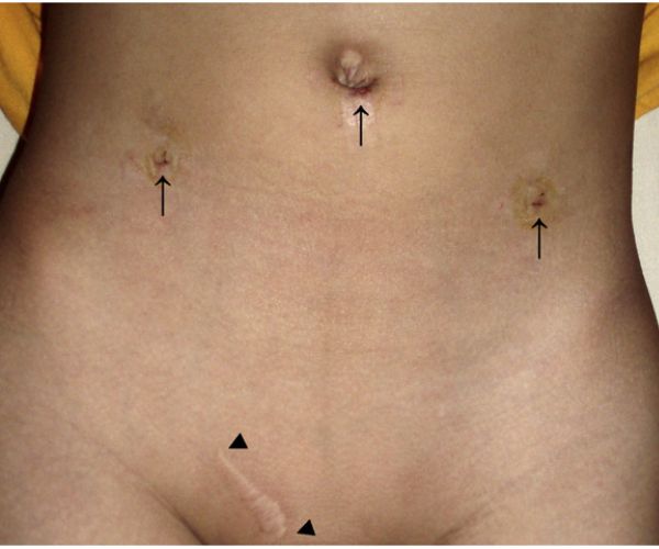 عملية الفتق بالمنظار للأطفال