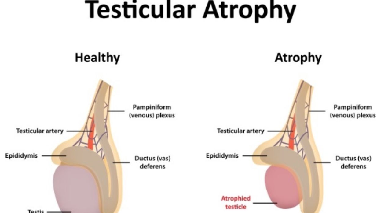 ضمور الخصية بعد عملية الفتق