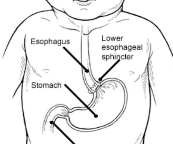ارتجاع المريء عند الرضع