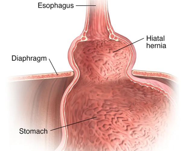 العلاقة بين ارتجاع المرئ وفتق الحجاب الحاجز