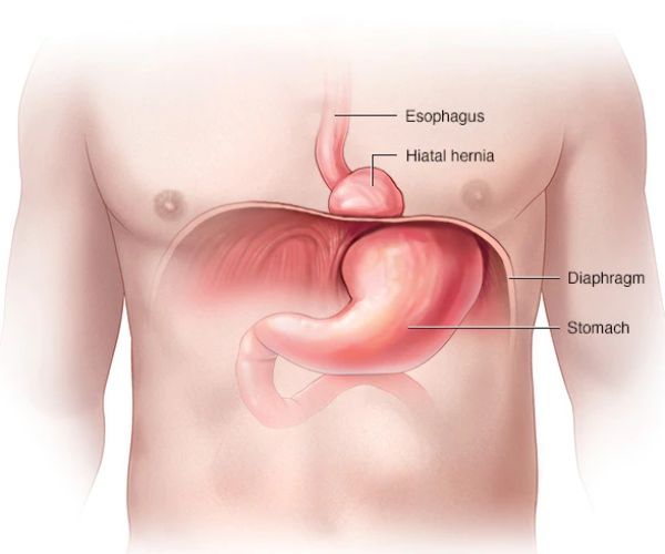 العلاقة بين ارتجاع المرئ وفتق الحجاب الحاجز